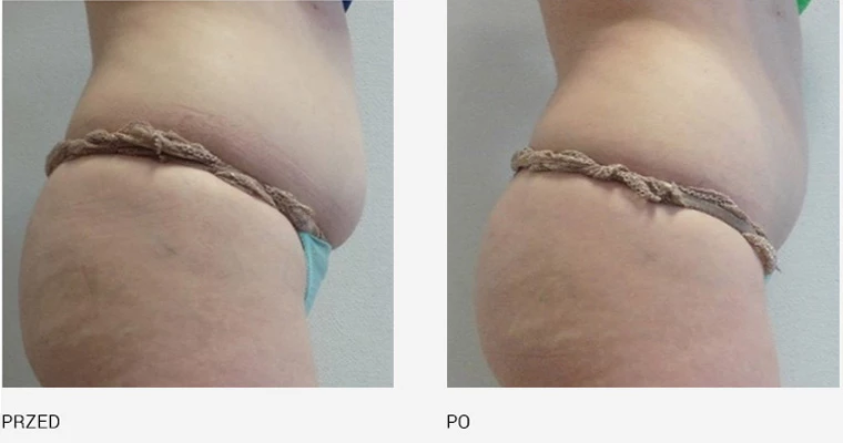 endermologia effekty