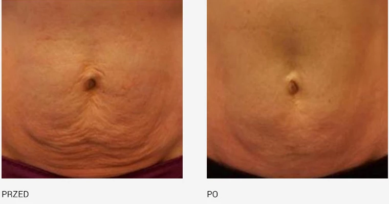 endermologia effekty