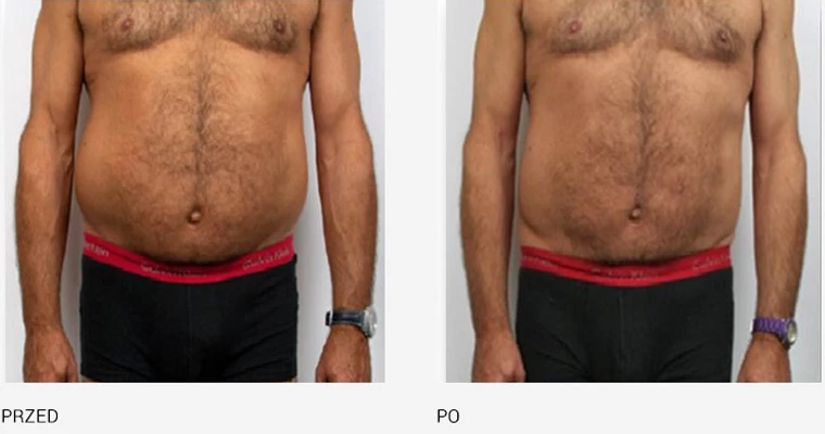 endermologia effekty