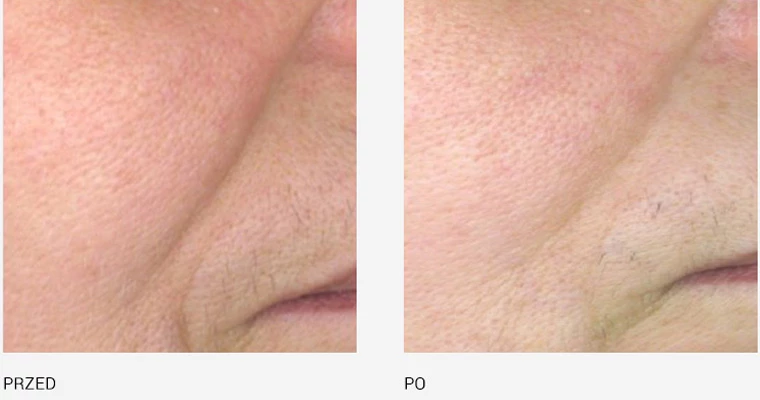 endermologia effekty