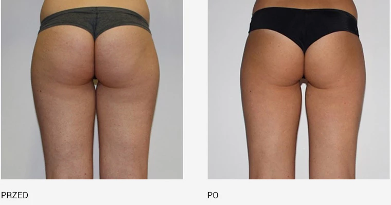 endermologia effekty