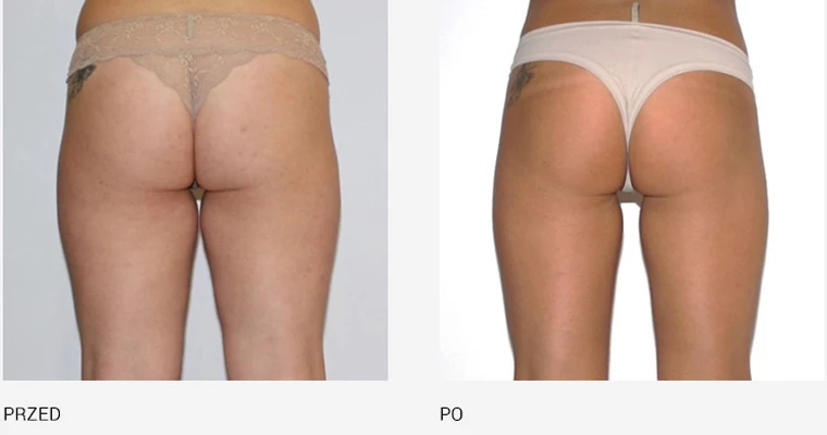 endermologia effekty